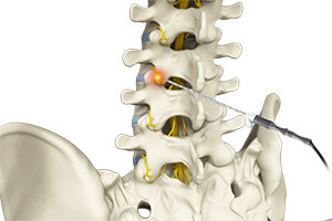 Lumbar Spondylosis Radiofrequency