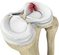 Meniscal Tear