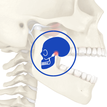 TMJ (TemporoMandibular Joint) Disorders