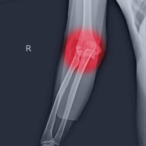 ELBOW DISLOCATION TREATMENT