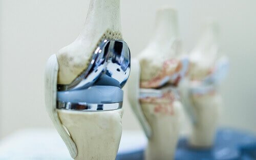 Total Knee Replacement TKR Abu Dhabi