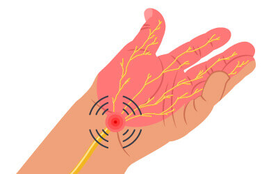 Carpal tunnel syndrome
