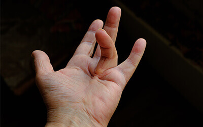 Dupuytren's contracture