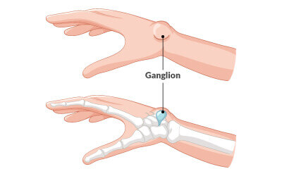 Ganglion cysts on wrist and hand