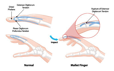 Mallet finger