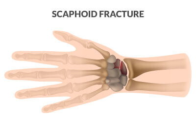 Scaphoid fracture
