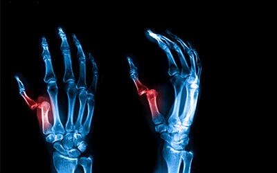thumb fracture