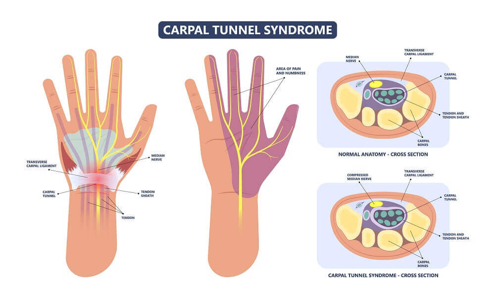 Carpal Tunnel Syndrome and Surgery