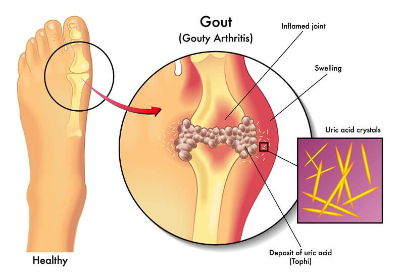 Gout Causes & Symptoms Gout Causes & Symptoms